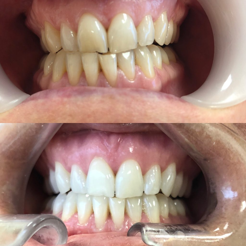 Teeth Whitening Leeds Garforth Enhance Dental Enhance Dental