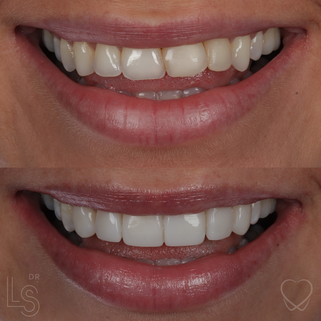 Composite Bonding Leeds Garforth Enhance Dental Enhance Dental
